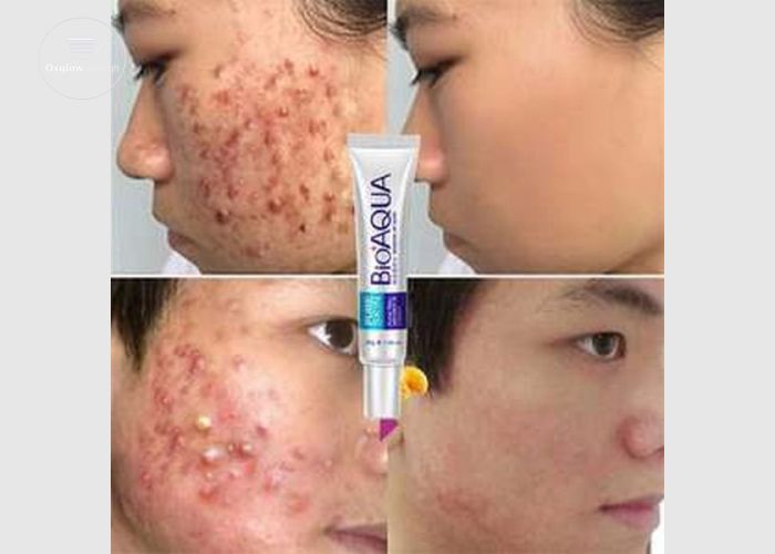 BioAqua Acne Removal Cream
