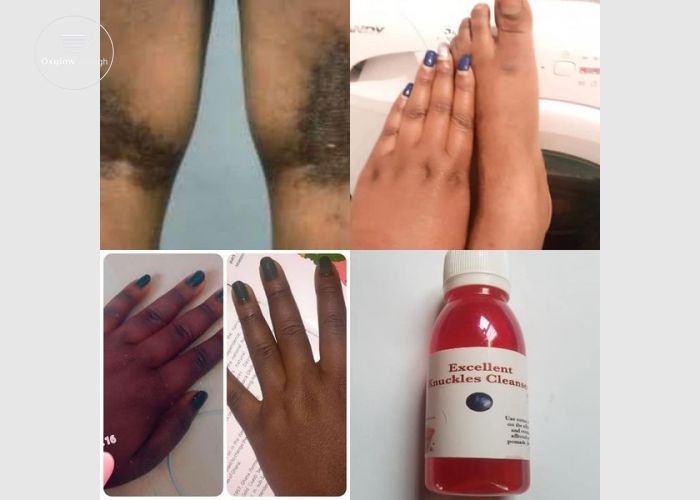Powerful Knuckles Removal
