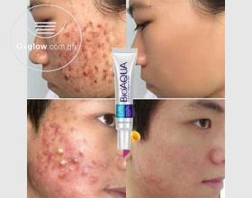 BioAqua Acne Removal Cream